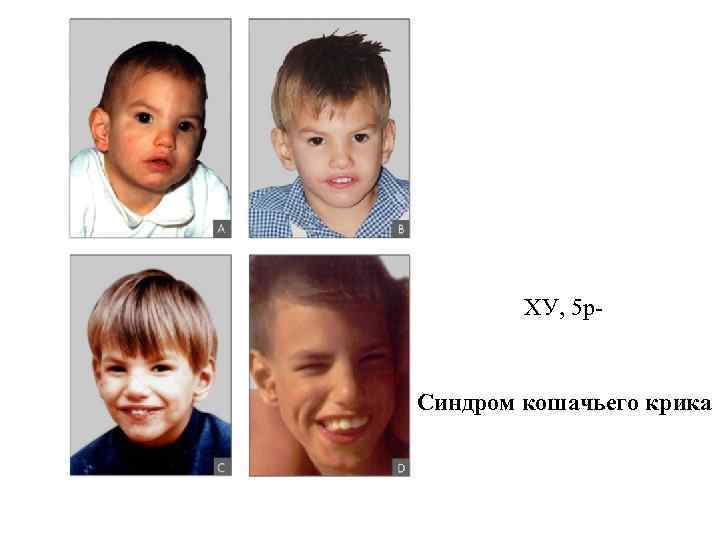 ХУ, 5 р- Синдром кошачьего крика 