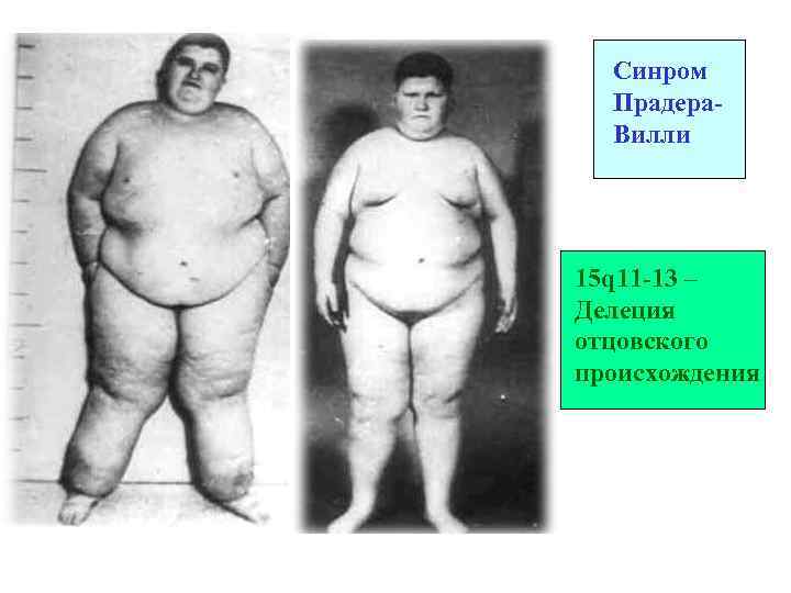 Синром Прадера. Вилли 15 q 11 -13 – Делеция отцовского происхождения 