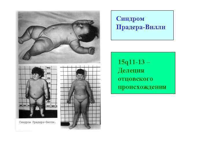 Синдром Прадера-Вилли 15 q 11 -13 – Делеция отцовского происхождения 