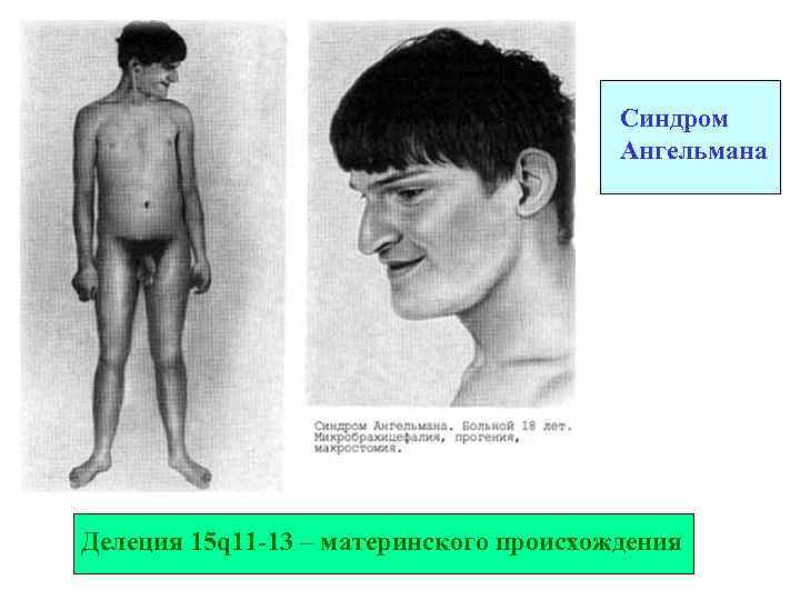 Синдром Ангельмана Делеция 15 q 11 -13 – материнского происхождения 