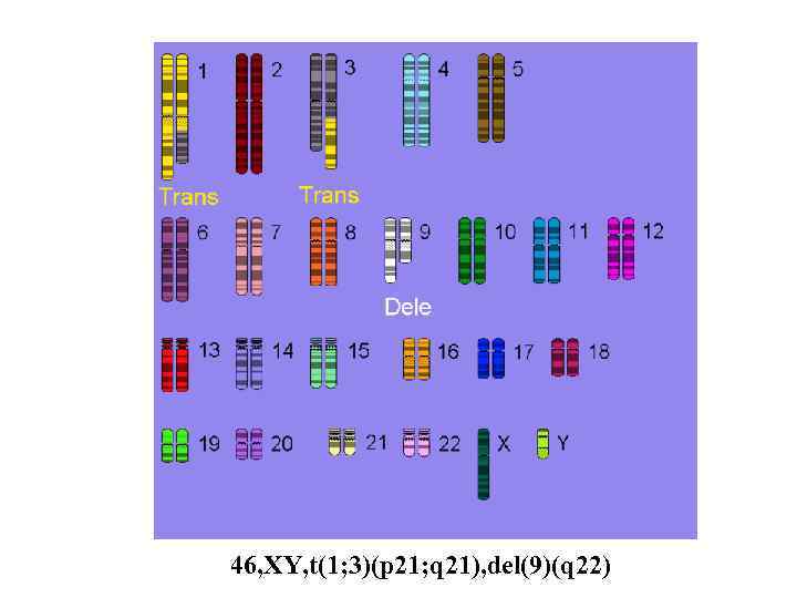 46, XY, t(1; 3)(p 21; q 21), del(9)(q 22) 