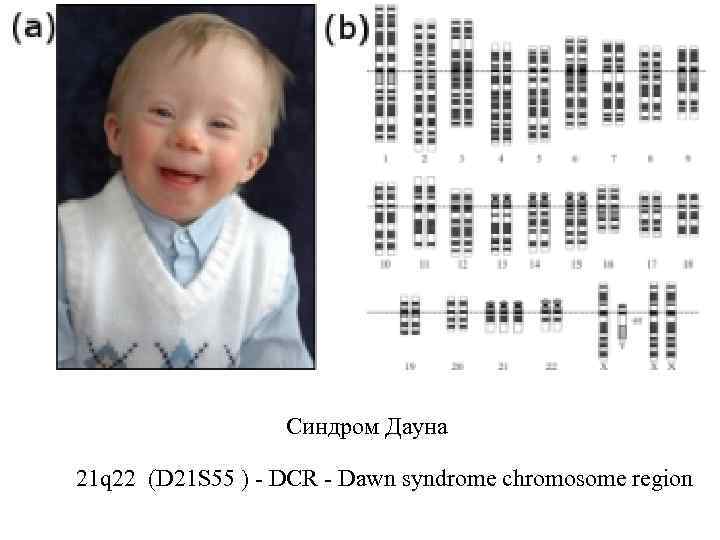 Хромосомы у дауна. Синдром Дауна носитель. Синдром Дауна прерывание беременности. Синдром Дауна при беременности.