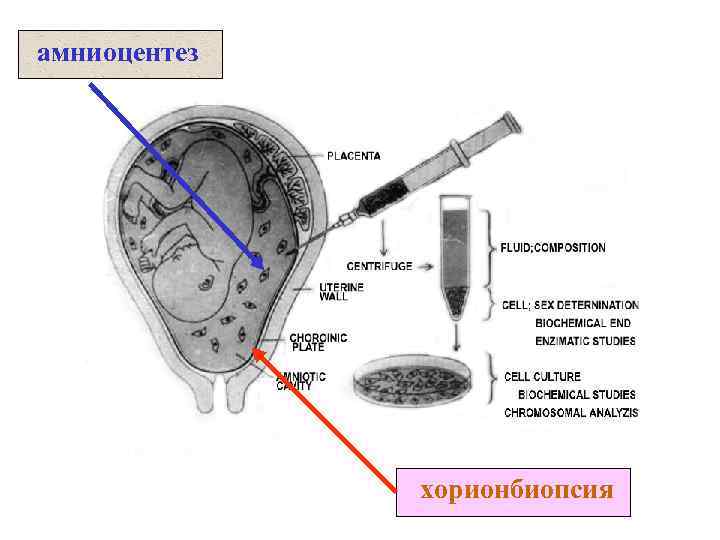 Результаты амниоцентеза фото