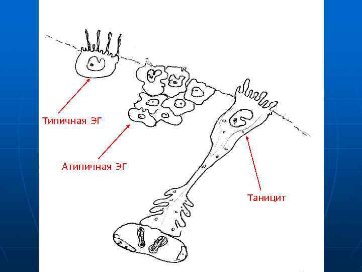 Типичная ЭГ Атипичная ЭГ Таницит 