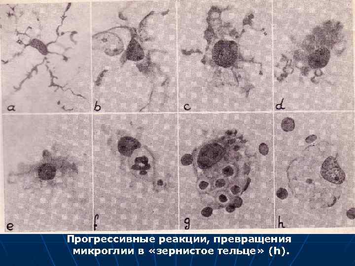 Прогрессивные реакции, превращения микроглии в «зернистое тельце» (h). 