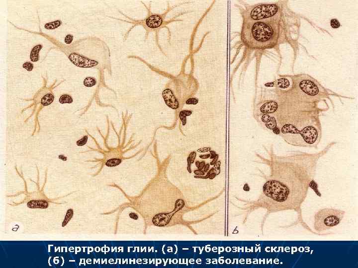 Гипертрофия глии. (а) – туберозный склероз, (б) – демиелинезирующее заболевание. 