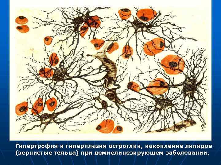 Гипертрофия и гиперплазия астроглии, накопление липидов (зернистые тельца) при демиелинезирующем заболевании. 