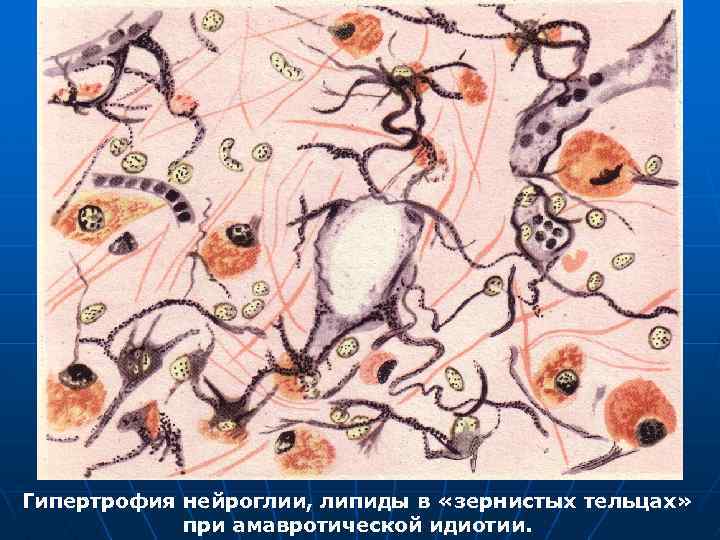 Гипертрофия нейроглии, липиды в «зернистых тельцах» при амавротической идиотии. 