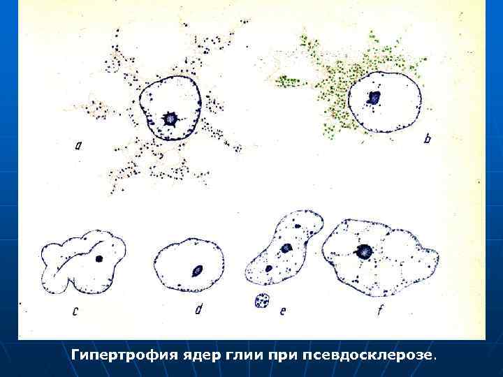Гипертрофия ядер глии при псевдосклерозе. 