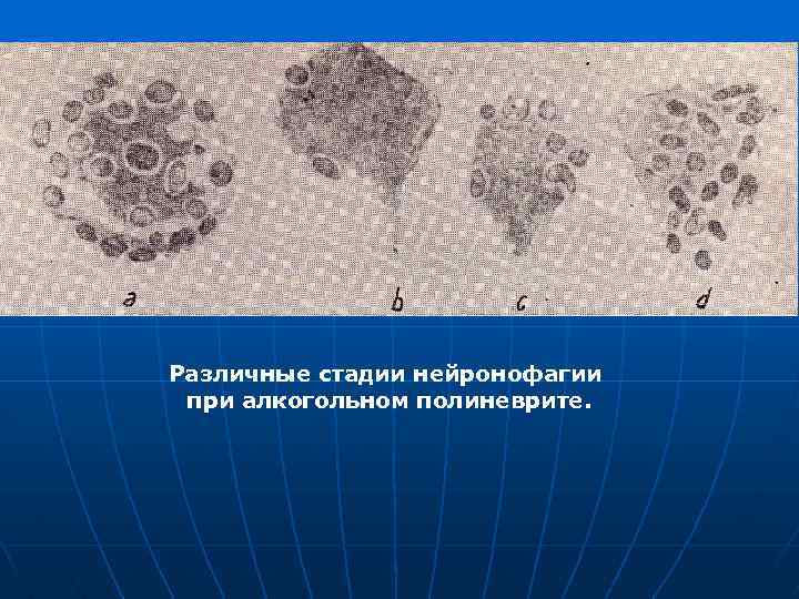Различные стадии нейронофагии при алкогольном полиневрите. 