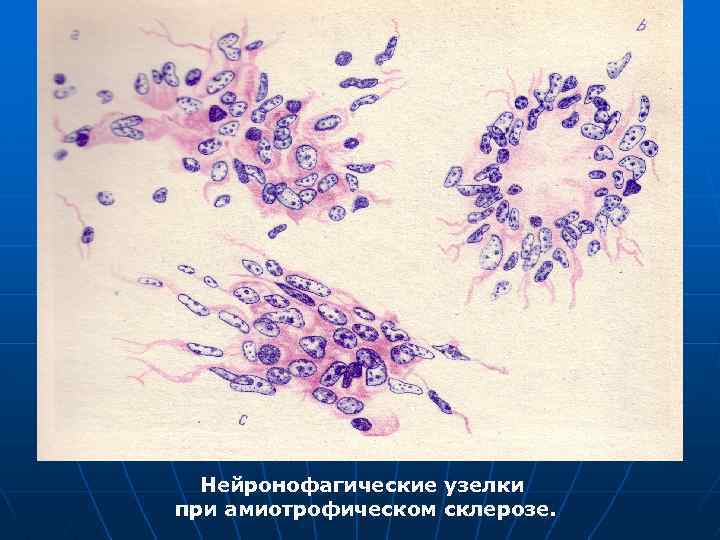 Нейронофагические узелки при амиотрофическом склерозе. 