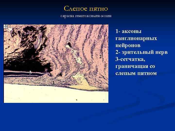 Слепое пятно окраска гематоксилин-эозин 2 3 1 1 - аксоны ганглионарных нейронов 2 -