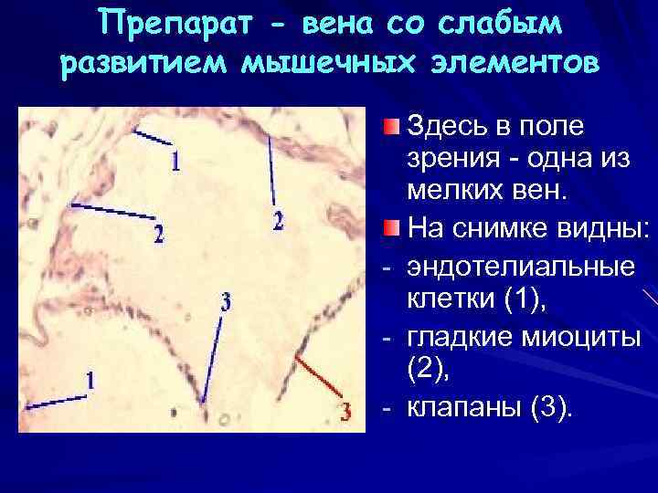 Препарат - вена со слабым развитием мышечных элементов Здесь в поле зрения одна из