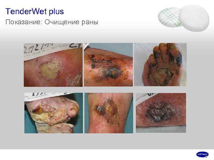 Tender. Wet plus Показание: Очищение раны 