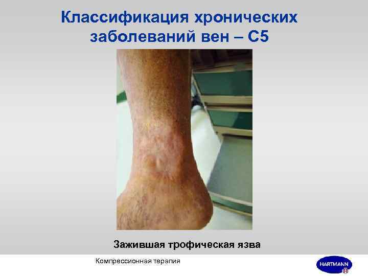 Классификация хронических заболеваний вен – С 5 Зажившая трофическая язва Компрессионная терапия 