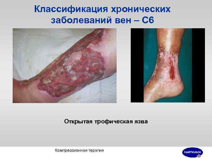 Классификация хронических заболеваний вен – С 6 Открытая трофическая язва Компрессионная терапия 