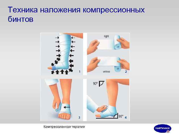 Техника наложения компрессионных бинтов Компрессионная терапия 