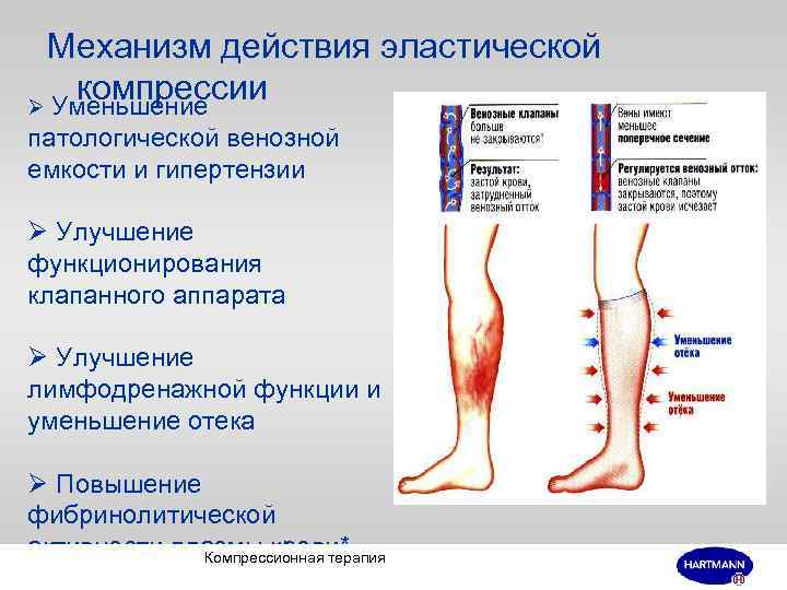 Клиническая картина компрессии корешков конского хвоста отличается от компрессии конуса и эпиконуса