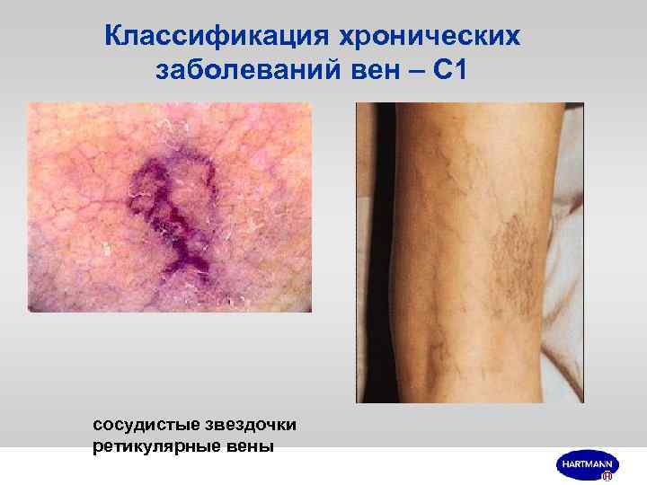 Классификация хронических заболеваний вен – С 1 сосудистые звездочки ретикулярные вены 