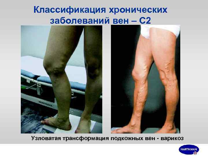 Классификация хронических заболеваний вен – С 2 Узловатая трансформация подкожных вен - варикоз 