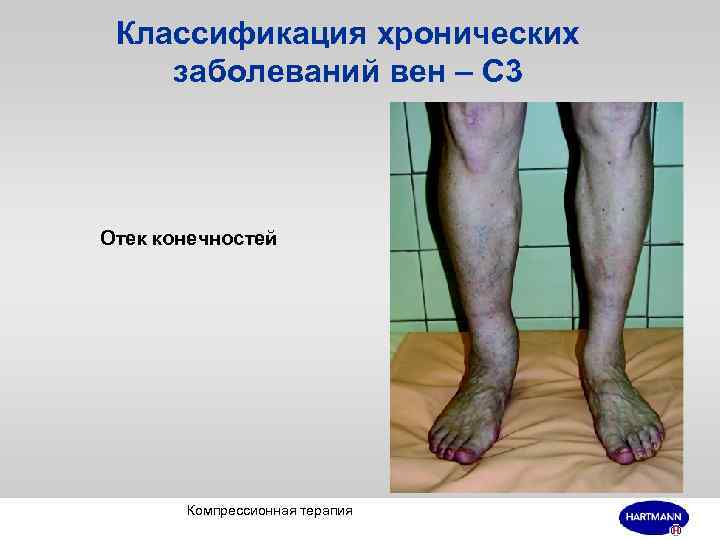 Классификация хронических заболеваний вен – С 3 Отек конечностей Компрессионная терапия 