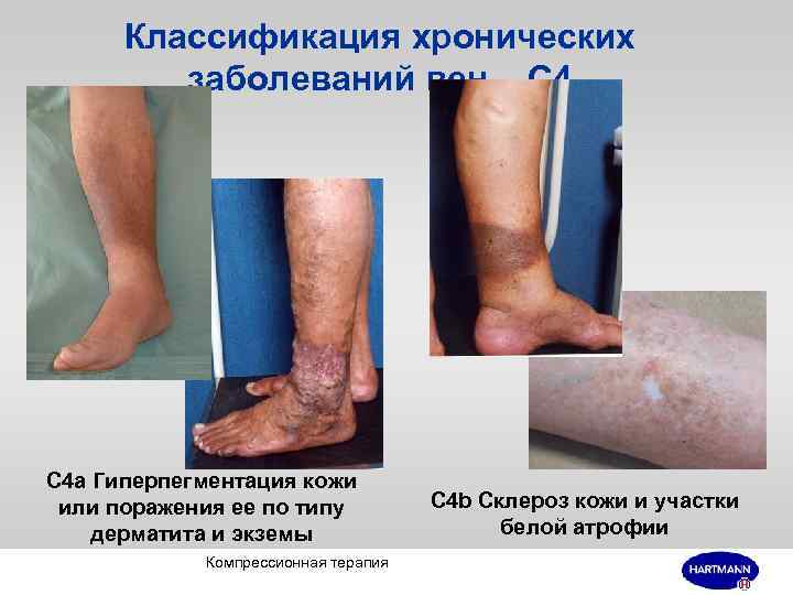 Классификация хронических заболеваний вен – С 4 а Гиперпегментация кожи или поражения ее по