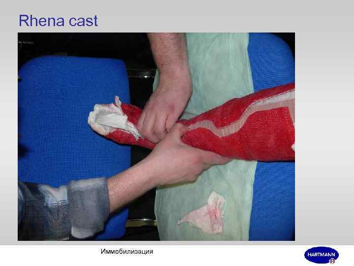 Rhena cast Иммобилизация 