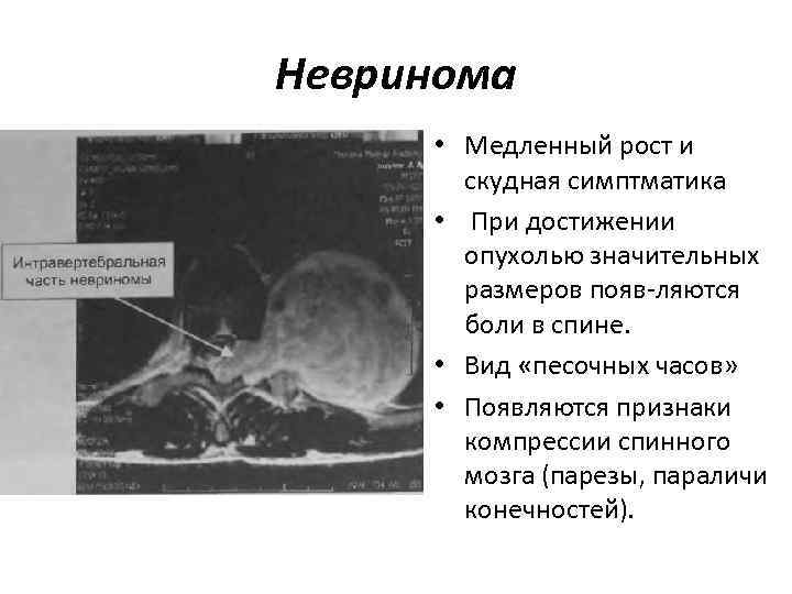 Невринома • Медленный рост и скудная симптматика • При достижении опухолью значительных размеров появ