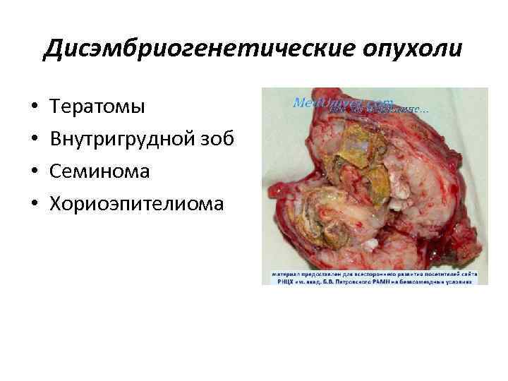 Дисэмбриогенетические опухоли • • Тератомы Внутригрудной зоб Семинома Хориоэпителиома 