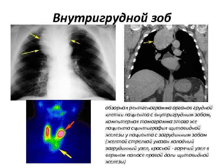 Внутригрудной зоб обзорная рентгенограмма органов грудной клетки пациента с внутригрудным зобом, компьтерная томограмма этого