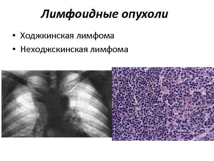 Лимфоидные опухоли • Ходжкинская лимфома • Неходжскинская лимфома 