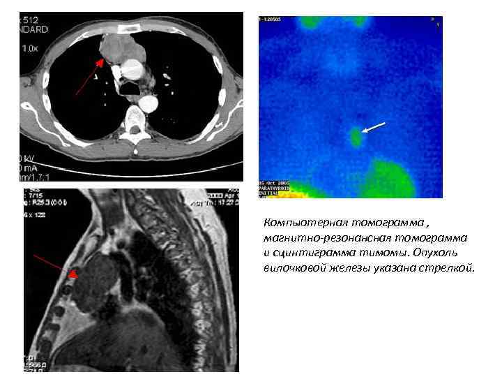 Компьютерная томограмма , магнитно-резонансная томограмма и сцинтиграмма тимомы. Опухоль вилочковой железы указана стрелкой. 