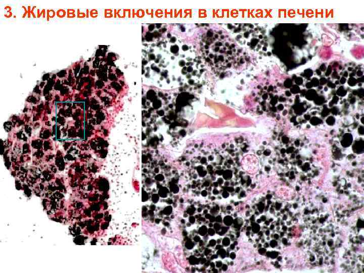 3. Жировые включения в клетках печени 