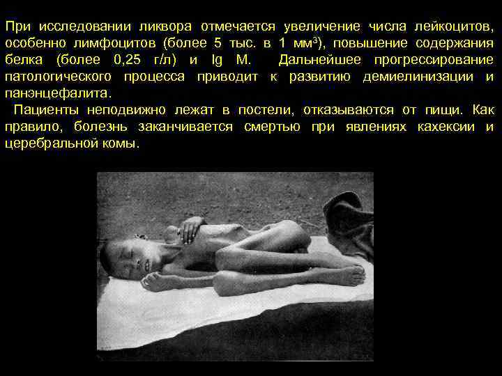 При исследовании ликвора отмечается увеличение числа лейкоцитов, особенно лимфоцитов (более 5 тыс. в 1