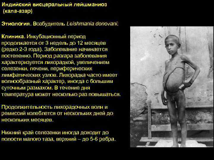 Индийский висцеральный лейшманиоз (кала-азар) Этиология. Возбудитель Leishmania donovani. Клиника. Инкубационный период продолжается от 3