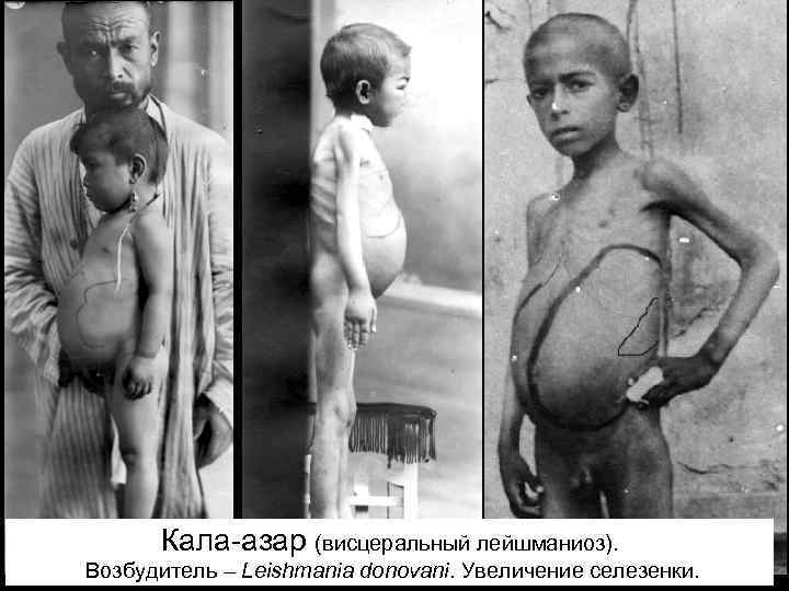 Кала-азар (висцеральный лейшманиоз). Возбудитель – Leishmania donovani. Увеличение селезенки. 