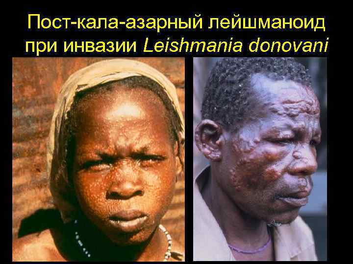 Пост-кала-азарный лейшманоид при инвазии Leishmania donovani 