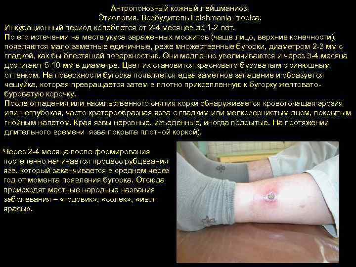 Антропонозный кожный лейшманиоз Этиология. Возбудитель Leishmania tropica. Инкубационный период колеблется от 2 -4 месяцев