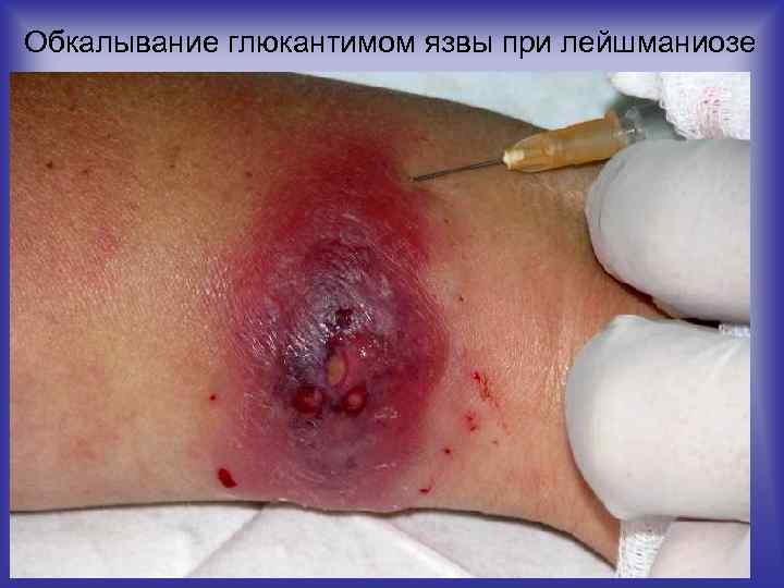 Обкалывание глюкантимом язвы при лейшманиозе 