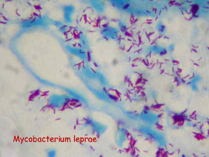 Mycobacterium leprae 