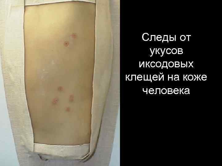 Следы от укусов иксодовых клещей на коже человека 