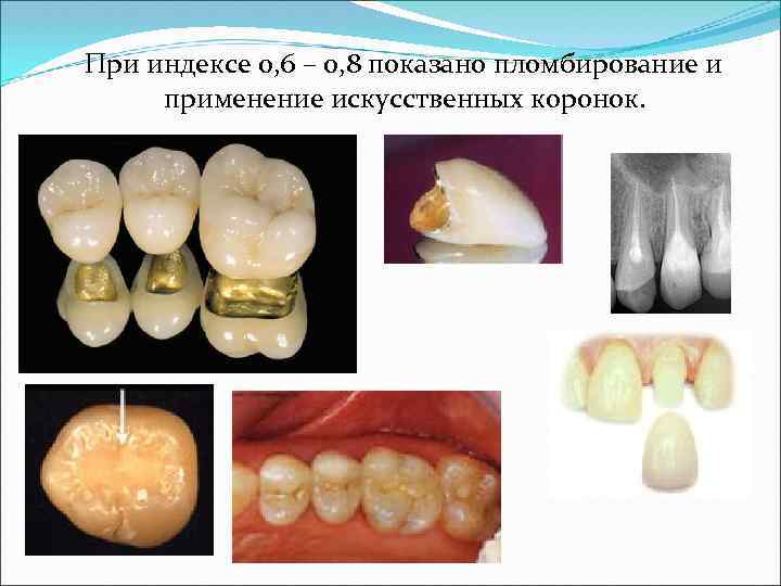  При индексе 0, 6 – 0, 8 показано пломбирование и применение искусственных коронок.