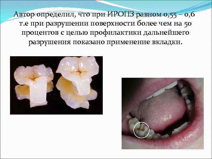 Идеальная схема окклюзионных контактов моляров и премоляров