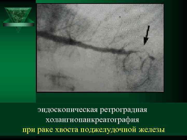 эндоскопическая ретроградная холангиопанкреатография при раке хвоста поджелудочной железы 