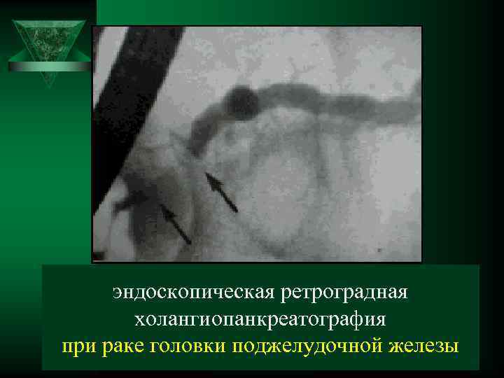 эндоскопическая ретроградная холангиопанкреатография при раке головки поджелудочной железы 