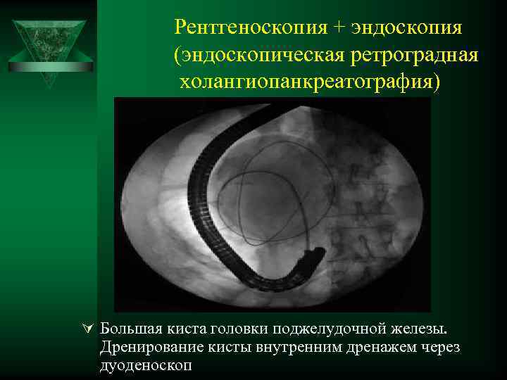 Рентгеноскопия + эндоскопия (эндоскопическая ретроградная холангиопанкреатография) Ú Большая киста головки поджелудочной железы. Дренирование кисты