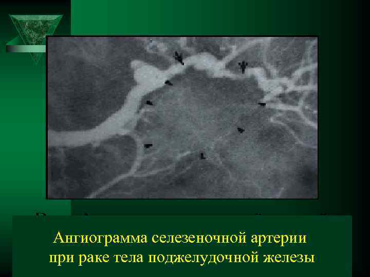 Ангиограмма селезеночной артерии при раке тела поджелудочной железы 