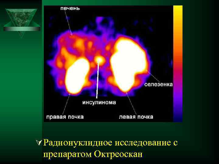 Ú Радионуклидное исследование с препаратом Октреоскан 