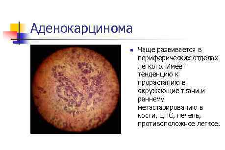 Аденокарцинома n Чаще развивается в периферических отделах легкого. Имеет тенденцию к прорастанию в окружающие