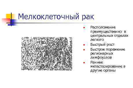 Мелкоклеточный рак n n Расположение преимущественно в центральных отделах легкого Быстрый рост Быстрое поражение